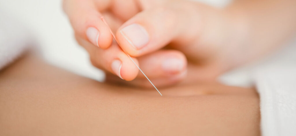 closeup of acupuncture needle and hand